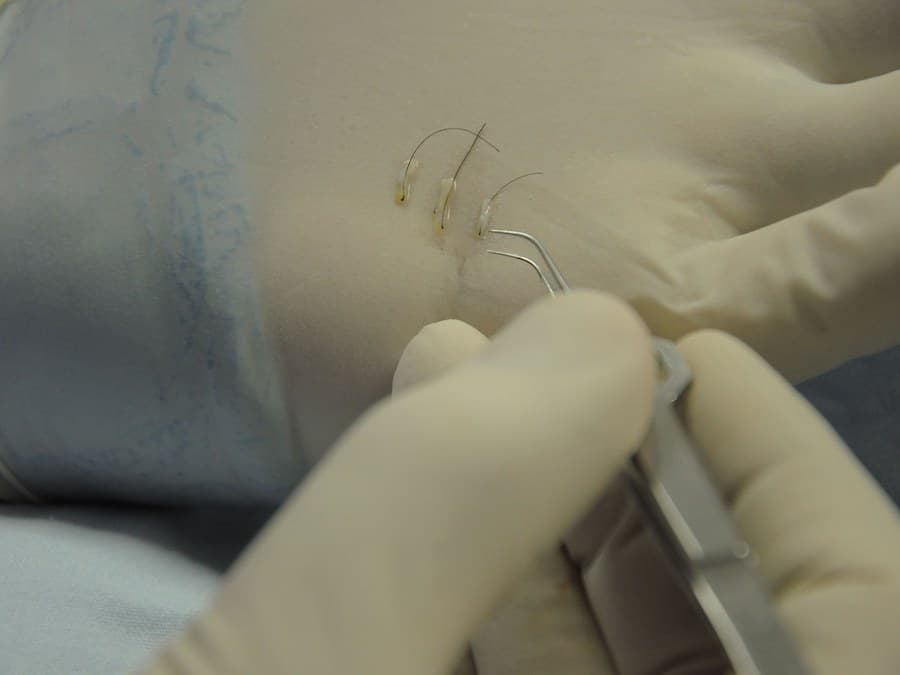 Close-up of forceps placing hair grafts during a transplant procedure