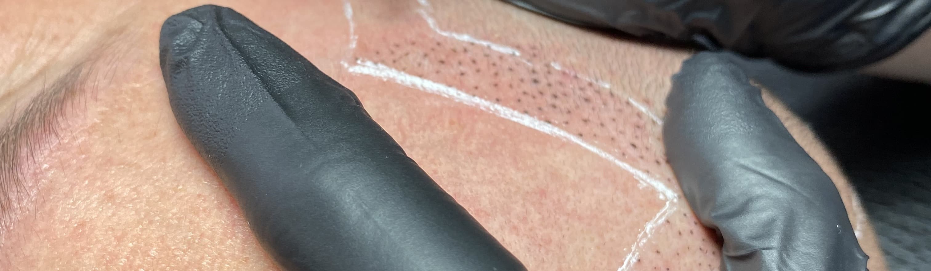 A practitioner's gloved hand using a scalp micropigmentation tool to deposit pigment dots along a hand-drawn hairline guide