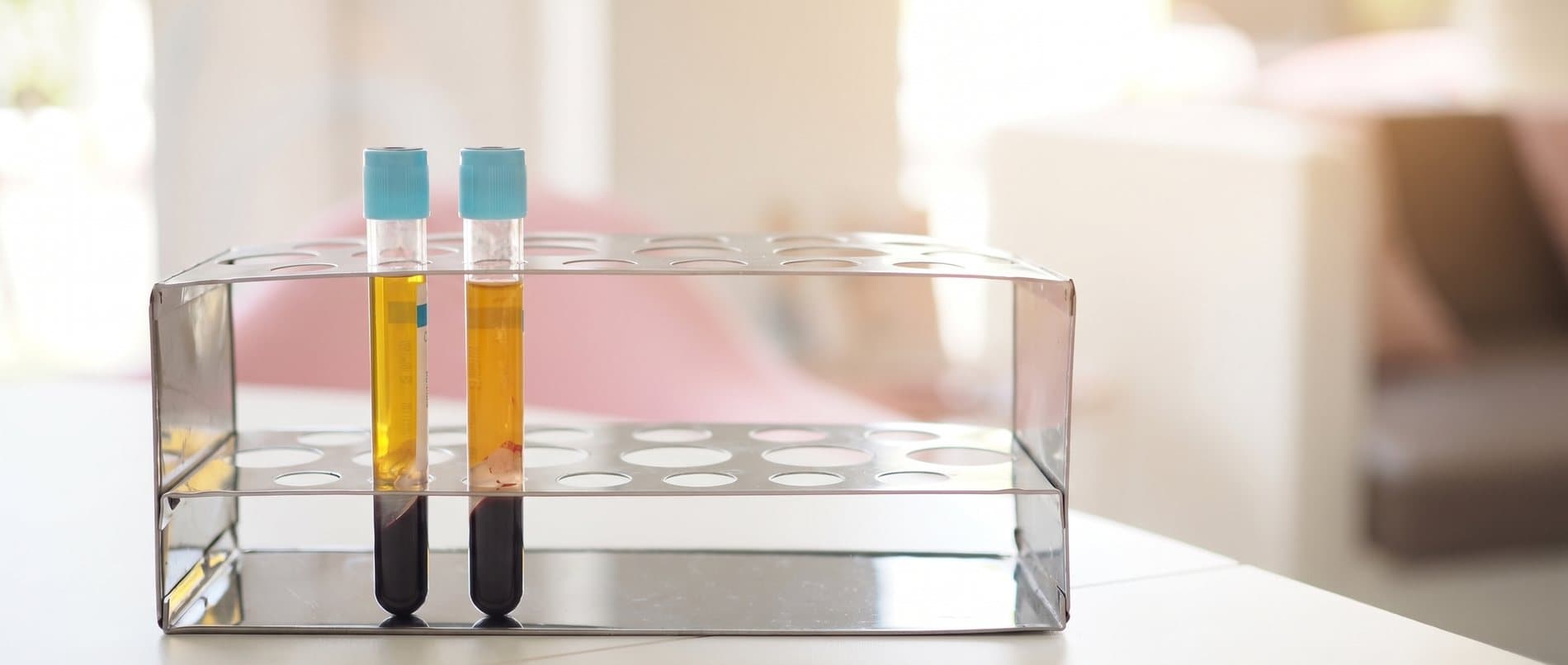 PRP blood sample tubes in a lab rack, prepared for regenerative hair treatment